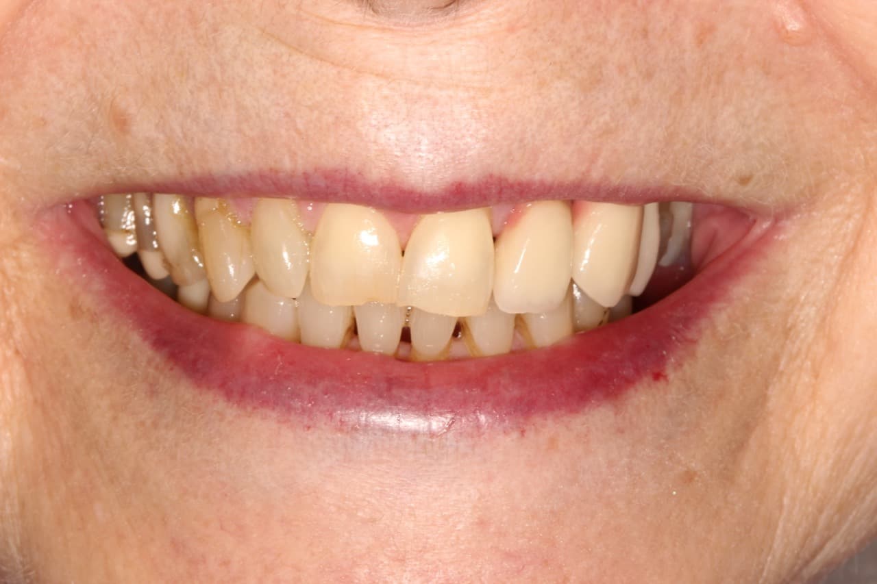 Full Mouth Rehabilitation — before